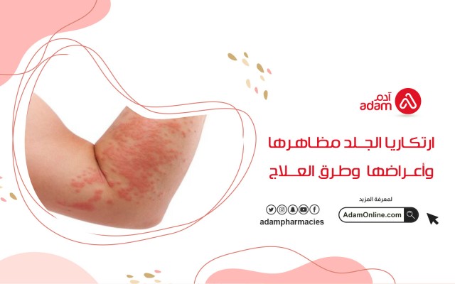 ارتكاريا الجلد مظاهرها وأعراضها وطرق العلاج